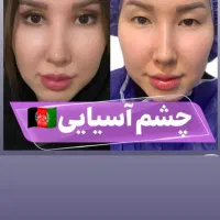 وقتش دوبار جوون بشی با بلفاروپلاستی