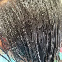 درمان قطعی رشک و شپش باکمترین هزینه