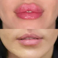 ژل وبوتاکس،فیلربادی پی آر پی،پیرسینگ،چال لپ