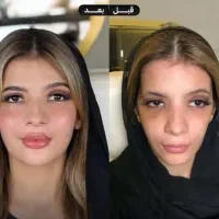 فیلر ،بوتاکس مزو