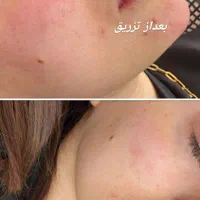 تزریق تخصصی ژل و بوتاکس رشت|خدمات آرایشگری و زیبایی|رشت, بلوار گیلان|دیوار