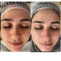 پاکسازی پوست وفشیال هزینه مواد۳۵۰تومن