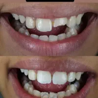 ترمیم و پر کردن دندان فقط ۱ میلیون و ۳۰۰