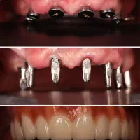 ایمپلنت، دندان پزشکی