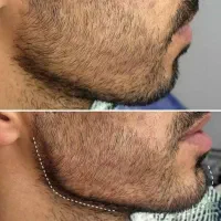 تزریق ژل دور چشم . بیکینی لیفت صورت بانخ مزوتراپی|خدمات آرایشگری و زیبایی|شاهین‌شهر, عطار|دیوار