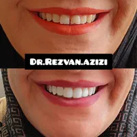 لمینت و کامپوزیت فوق حرفه ای در دندانپزشکی بینظیر|خدمات آرایشگری و زیبایی|شیراز, ملاصدرا|دیوار