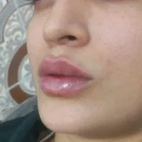 تخفیف ژل/بوتاکس/مزو/آنزیم/ساکشن غب غب|خدمات آرایشگری و زیبایی|اهواز, کیانپارس |دیوار