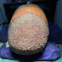 کاشت مو طبیعی له روش میکروfit وsut