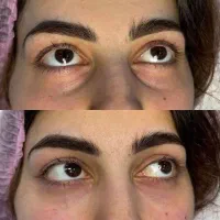تزریق فیلر بوتاکس فیشال درمان لک جوش چین و چروک|خدمات آرایشگری و زیبایی|محمدشهر, محمدشهر|دیوار