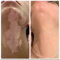 رفع قطعی و ریشه ای پیسی و پسوریازیس