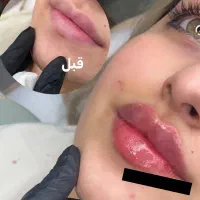 تزریق فیلر و بوتاکس(تخفیفمونو از دست نده)|خدمات آرایشگری و زیبایی|شهریار, شهرک وائین|دیوار