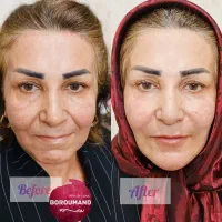 جشنواره ژل لب/فیلرلب/بوتاکس/آنزیم/هایفو توسط پزشک|خدمات زیبایی و سلامت|مشهد, هدایت|دیوار