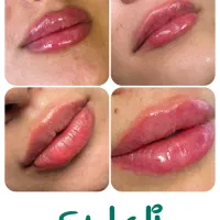 تزریق بوتاکس، فیلر لب، چانه، گونه، خط خنده در رشت