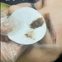 ریموو تتو با مواد آمریکایی تضمین سلامت پوست|خدمات آرایشگری و زیبایی|همدان, |دیوار