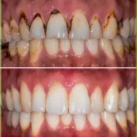 بیمار جرم گیری
