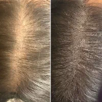 میکرواسکالپ-smp|خدمات آرایشگری و زیبایی|رشت, گلسار|دیوار