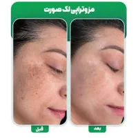 مزونیدلینگ ( مزوتراپی )