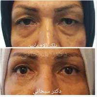 جراحی پلک بلفاروپلاستی لیفت ابرو شقیقه صورت پیشانی|خدمات آرایشگری و زیبایی|تهران, سلسبیل شمالی|دیوار