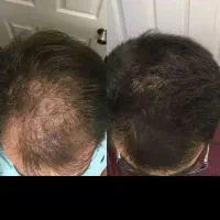 مزوتراپی ممنوع