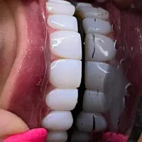 تخفیف جشنواره کامپوزیت،روکش