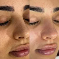 فیشیال تخصصی و خالبرداری|خدمات زیبایی و سلامت|مشهد, توس (بلوار توس)|دیوار