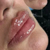تخفیف فیلر لب فقط امروز یک تومن
