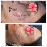 رفع جای جوش تضمینی|خدمات آرایشگری و زیبایی|اصفهان, وحید|دیوار