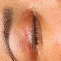 بلفاروپلاستی