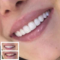 کامپوزیت دندان روکش لمینیت ایمپلنت