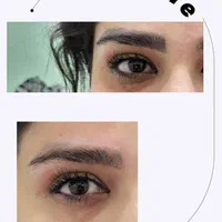 پاک کردن تتو صورت و بدن با دستگاه لیزر کیوسوییچ|خدمات آرایشگری و زیبایی|فلاورجان, |دیوار