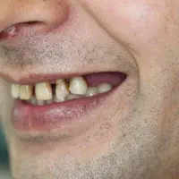 ایمپلنت اقساط بدون پول پیش تضمینی|خدمات آرایشگری و زیبایی|اصفهان, دشتستان|دیوار