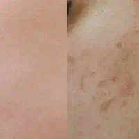 شستشوی گوش،برداشت خال،میکرو ومزونیدلینگ توسط پزشک