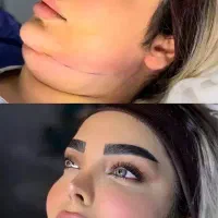ساکشن سوپر کانتور بلفارو بوکال تزریق چربی سانترال