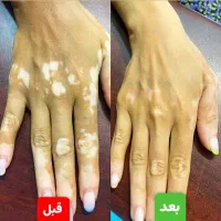 درمان دائمی بیماری پیسی وپسوریازیس واگزما|خدمات آرایشگری و زیبایی|امیدیه, |دیوار