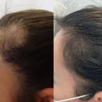 ما محصول ما دیگه نیاز نیست کاشت مو انجام بدی