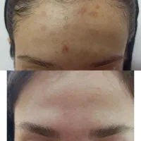حذف لک و منافذ باز و جای جوش/زیر نظر متخصص پوست|خدمات آرایشگری و زیبایی|مشهد, الهیه|دیوار