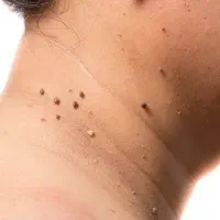 فرمولاسیون گیاهی رفع زگیل و خالهای گوشتی