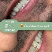 ایملپنت یک روزه بدون درد قسطی