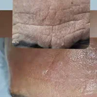 جوانسازی،درمان مشکلات پوست.سالک.آبله.منافذبازاسکار|خدمات آرایشگری و زیبایی|شیراز, بعثت|دیوار