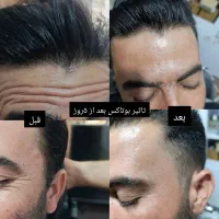 لیفت وجوانسازی با نخ های کاگ و تزریق فیلر ومزوها|خدمات آرایشگری و زیبایی|شیراز, میانرود|دیوار