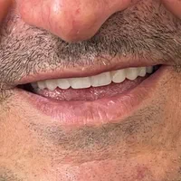 دست دندان متحرک/تعمیر دندان مصنوعی|خدمات آرایشگری و زیبایی|کرج, چهارصد دستگاه|دیوار