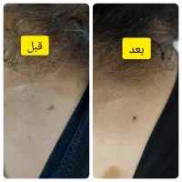 برداشتن خال و انواع ضایعه پوستی|خدمات آرایشگری و زیبایی|گرگان, |دیوار