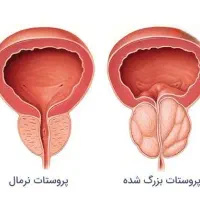 بهبود بیماری پروستات و اختلالات آقایان