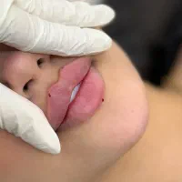 ژل لب روسی نچرال .بدون کبودی و گلوله توسط پزشک