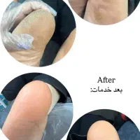 پدیکور کفسابی تضمینی ترک عمیق پا در یک جلسه
