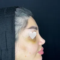 عمل جراحی بینی توسط متخصص زیباییent/ترمیم بینی|خدمات آرایشگری و زیبایی|کرج, چهارصد دستگاه|دیوار
