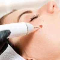 برداشت خال و ضایعات پوستی
