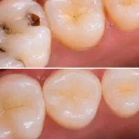 ترمیم دندان با تعرفه دولتی