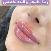 تزریق فیلر بادی تزریق چربی صورت تزریق ژل و بوتاکس