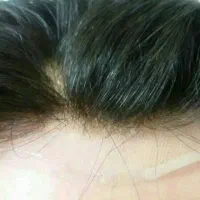 پروتز مو ترمیم|خدمات آرایشگری و زیبایی|اندیشه, اندیشه فاز ۱|دیوار